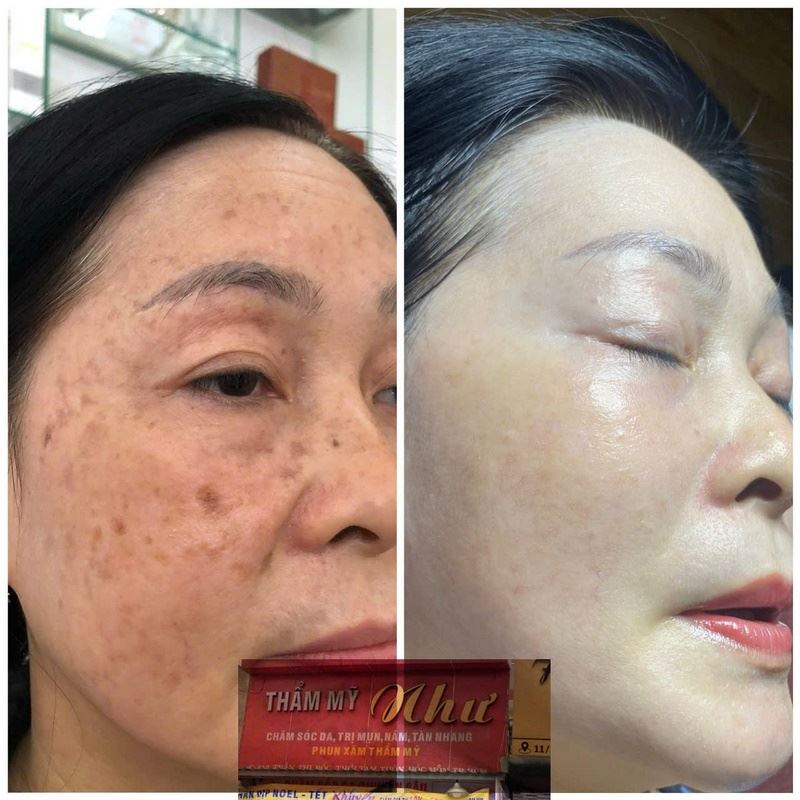 Hiệu quả điều trị mụn - nám - tàn nhang tại Như Spa Beauty