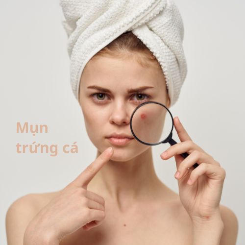 4 Nguyên Nhân Chính Gây Nên Mụn